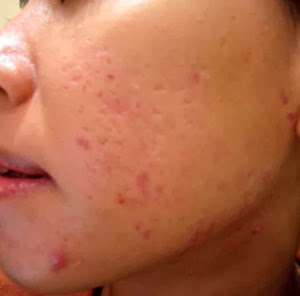 Bật mí 5 cách trị sẹo mụn tại nhà siêu đơn giản 1 Bật mí 5 cách trị sẹo mụn tại nhà siêu đơn giản 1
