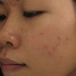 Xóa sẹo thâm ở mặt bằng công nghệ Peeling có an toàn không?