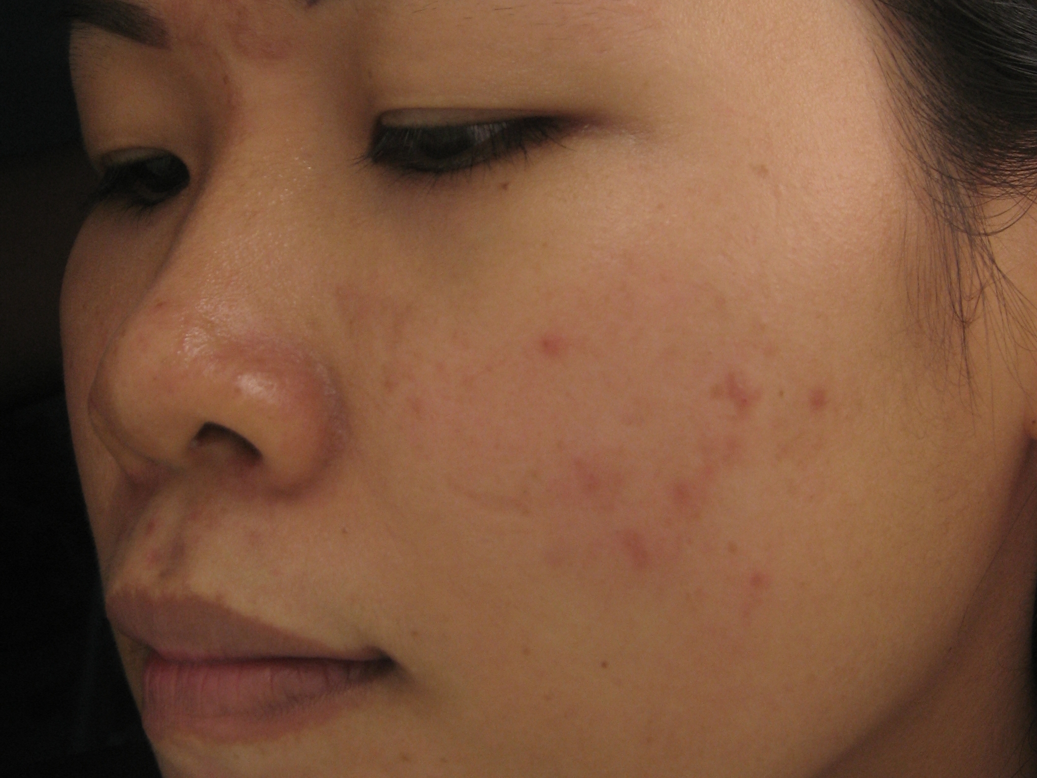 Xóa sẹo thâm ở mặt bằng công nghệ Peeling có an toàn không?