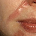 “Bày cách” trị sẹo lồi trên mặt không phải phẫu thuật
