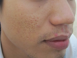 Cách trị sẹo mụn lâu năm trên mặt hiệu quả và tiết kiệm thời gian?