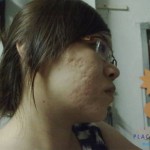Có cách trị sẹo mụn đơn giản mà hiệu quả nhanh chóng không?