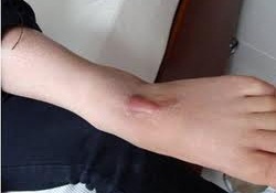Cách trị sẹo lồi ở chân nào hiệu quả nhất hiện nay? Hỏi đáp chuyên gia