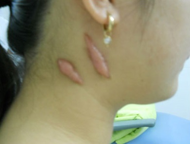 Trị sẹo lồi ở cổ bằng Laser Co2 Fractional có đảm bảo an toàn không?