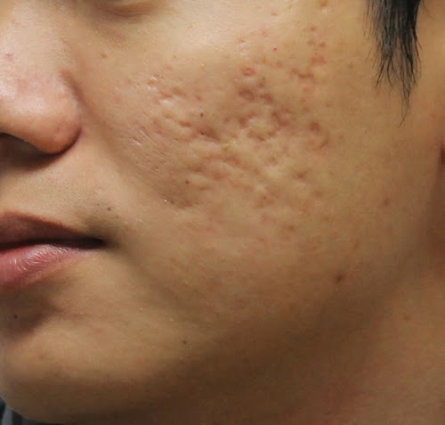 Trị sẹo sau mụn bằng công nghệ kim lăn có hiệu quả không?