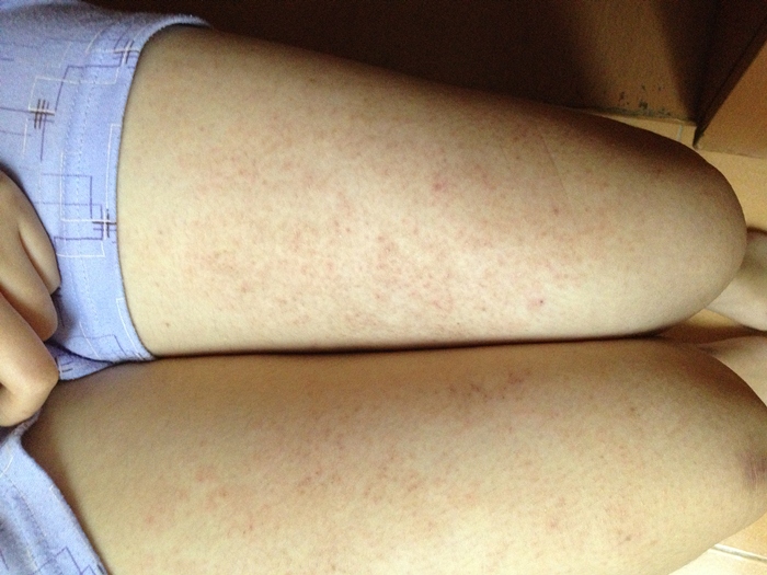 Trị sẹo thâm ở chân bằng tinh chất Peeling có hiệu quả không?