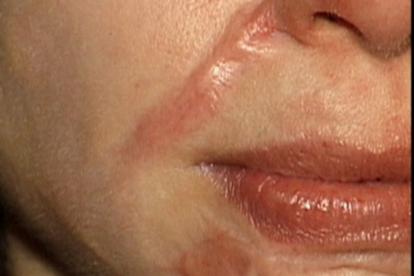 Đã có cách trị sẹo lồi trên da mặt: triệt để - an toàn – tiết kiệm thời gian 1