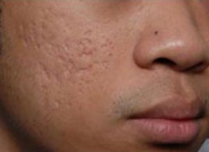 Phương pháp nào điều trị sẹo rỗ hiệu quả cao nhất?