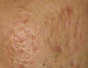 Cách nào trị sẹo rỗ do mụn để lại nhanh chóng và triệt để?