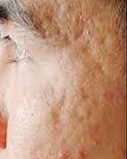 Cách nào trị sẹo rỗ trên mặt hiệu quả nhanh chóng?