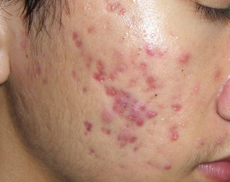 Có cách trị sẹo thâm lâu ngày triệt để trong thời gian ngắn không?