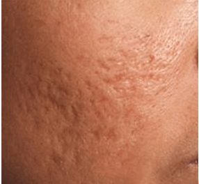 Sẹo rỗ lâu năm do mụn có điều trị hết được không?