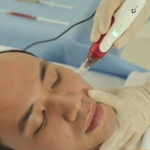 Công nghệ cấy da siêu vi điểm được ưa chuộng trong trị sẹo lõm, sẹo rỗ