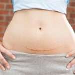Những nguyên tắc trong phòng ngừa và điều trị sẹo sau phẫu thuật