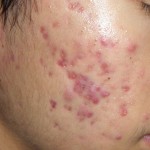 Tận hưởng cảm giác tự tin, không còn nỗi lo sẹo mụn