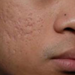 “Tự chế” 3 công thức trị sẹo rỗ bằng phương pháp tự nhiên