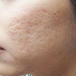 Nên chữa sẹo rỗ bằng thuốc hay phương pháp phẫu thuật?