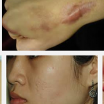 Thoát khỏi nỗi lo bị sẹo lồi, lõm “dai dẳng”