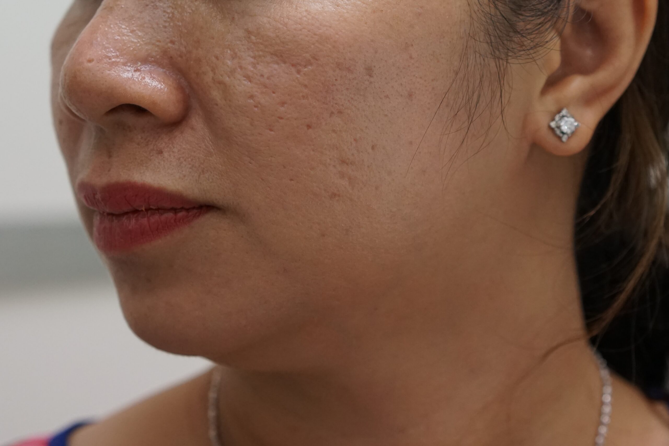 Trị sẹo lõm bằng cấy da siêu vi điểm giá bao nhiêu?