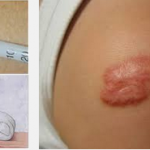 Điều trị sẹo lồi bằng Laser Co2 Fractional có an toàn không?