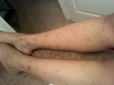 Kem trị sẹo thâm ở chân và những nguy cơ tiềm ẩn