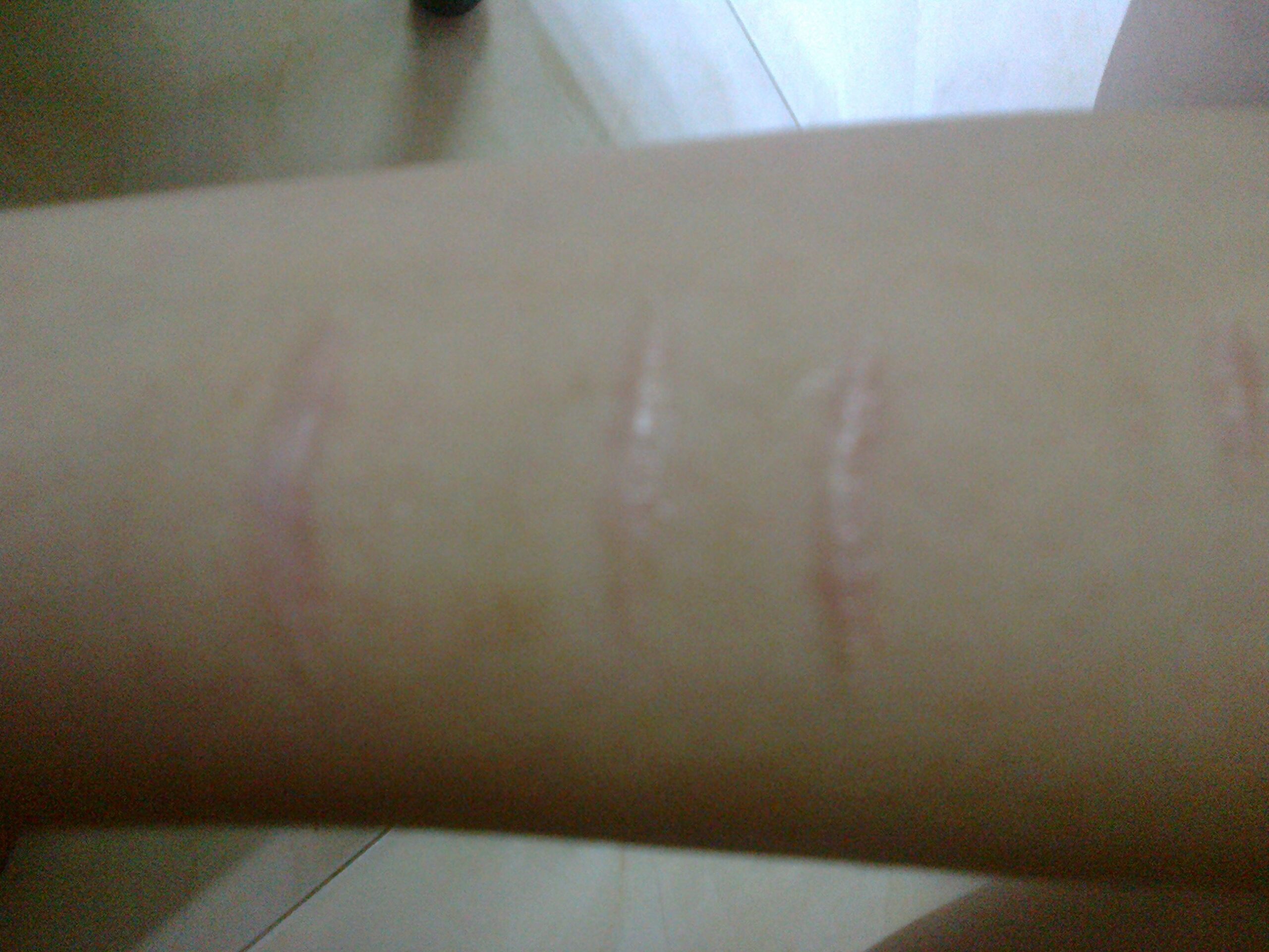 Cách điều trị sẹo lồi lâu năm nhanh chóng hiệu quả nhất  2016