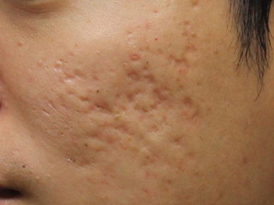 Khắc phục đáng kể sẹo rỗ ở mặt nhờ liệu pháp đột phá – Câu chuyện của anh Đức Phong