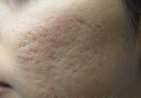 Bí quyết làm đầy sẹo lõm lâu năm của tôi…