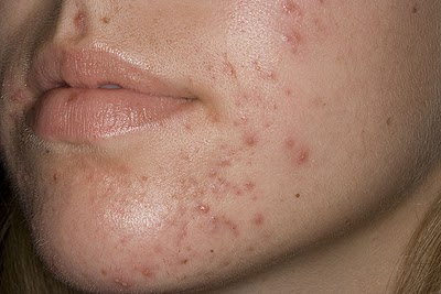 Bí kíp xóa sẹo thâm ở mặt nhanh nhất – Tự sự của 9X Sài Thành