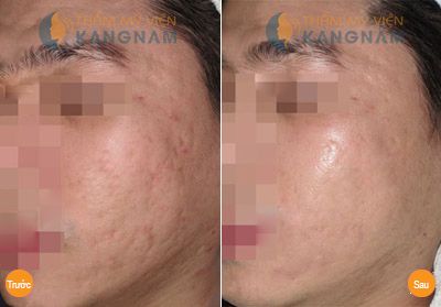 Xóa sẹo rỗ ở mặt hiệu quả tới 90% với công nghệ hiện đại