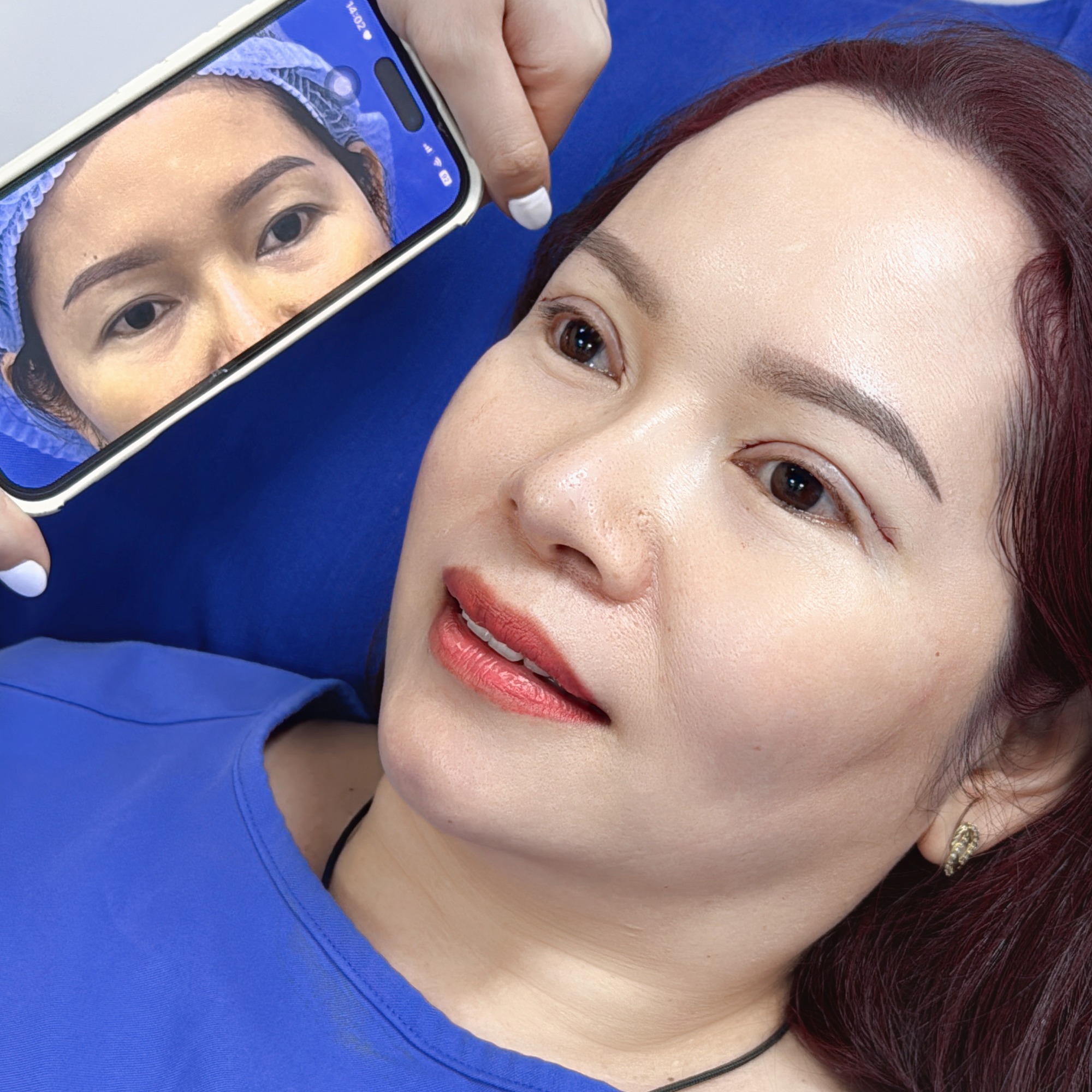 Mí mắt sau khi cắt sẽ hơi sưng tấy, bầm tím những ngày đầu